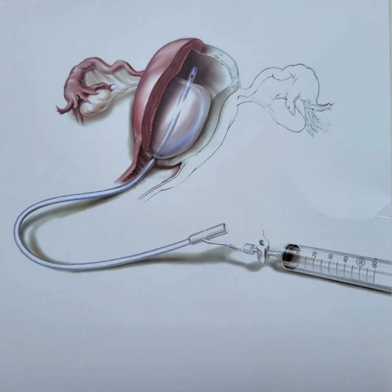 Triangle uterine stent
